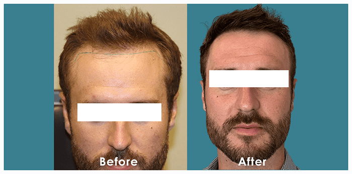 "Frontal view of a BKS Hair Restoration patient, with the 'before' image showing a receding hairline and the 'after' image displaying a fuller hairline.